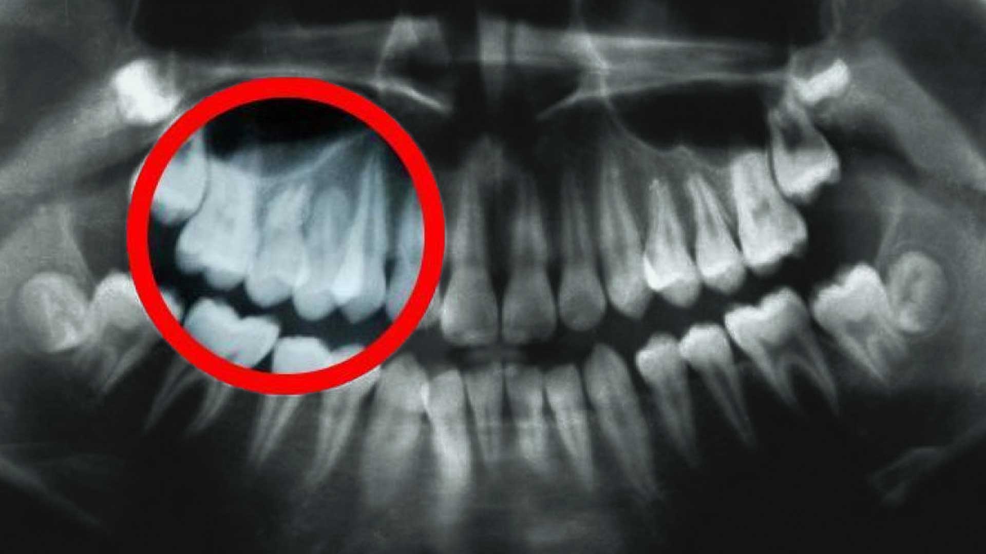 Los científicos pueden hacer crecer los dientes de nuevo, di adiós a los implantes